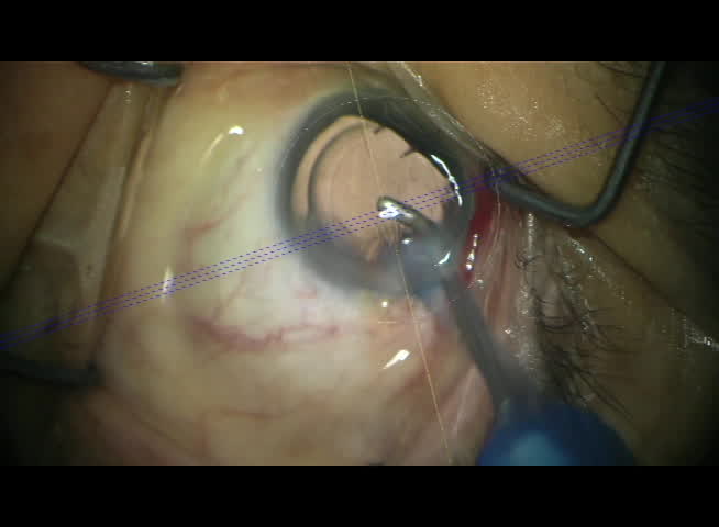 Positioning a Toric IOL with Callisto Guidance