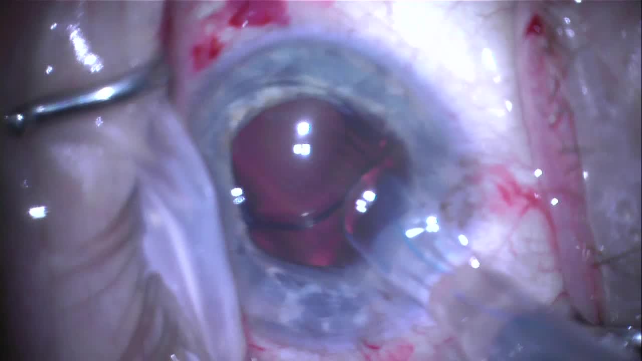  IOL Exchange With Scaffold Technique
