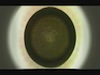 Evolution of Femtosecond Lenticule Extraction Treatment for Refractive Errors