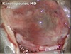 Gunderson Flap in Severe External Disease