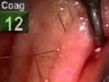 Closing the Fornix Based Conjunctival Flap