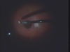 Vitreous Cyst