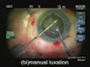 Management of Posterior Capsule Hole