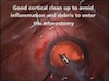 One Site Combined Trabeculectomy and Cataract Surgery