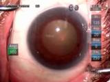 Pseudoexfoliation and the Small Pupil