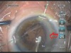 Cataract Surgery in an Eye with Weak Zonules Using Capsule Support Hooks
