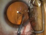 Cataract Surgery on a Hyperopic Patient