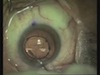 enVista Toric Implantation