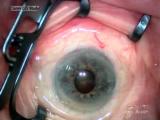 Cataract Surgery in an Eye With a Small Pupil
