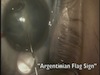 Complicated Cataract - Managing the Argentinian Flag Sign