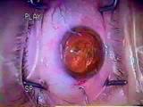 Using Hydrodissection