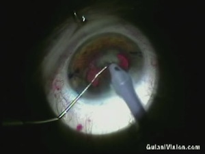 FemtoLaser Cataract Surgery: A Necessity?