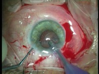 Combined Fluid-Gas Exchange and Cataract Extraction