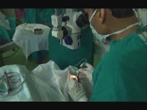 India's First Implantation of AMO Tecnis Multifocal Toric IOL