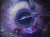 Combined Sutureless Vitrectomy and Phaco Free Cataract Surgery