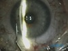 Raindrop Implantation