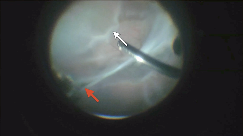 Toxoplasmosis-ROP Retinal Detachment