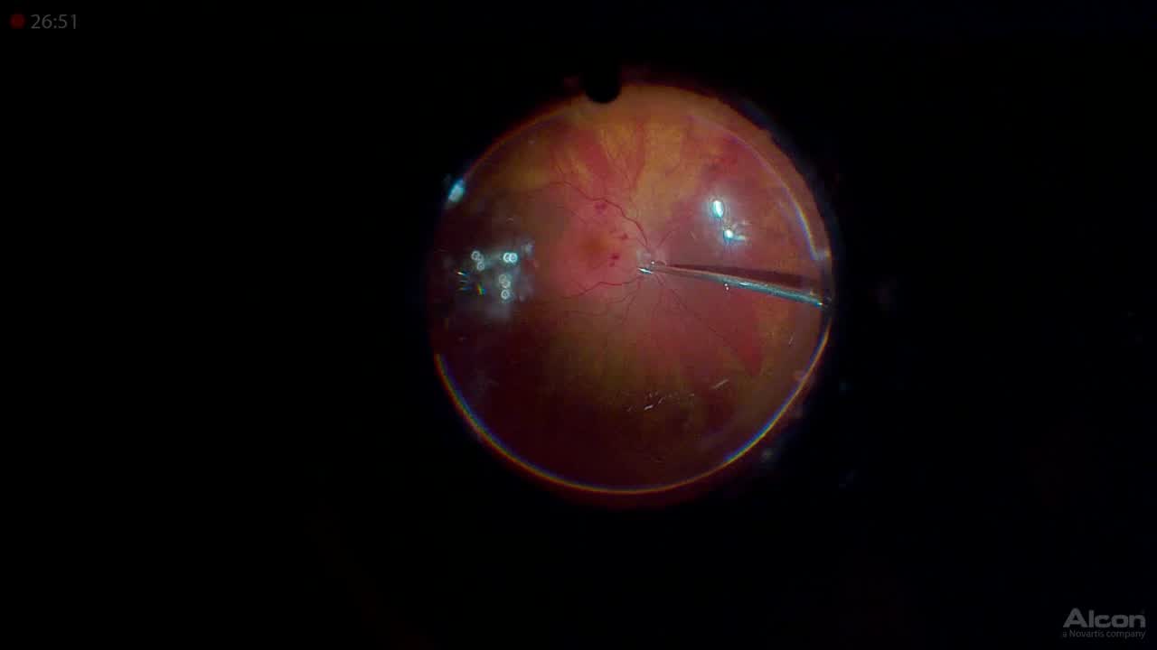 Macular Hole