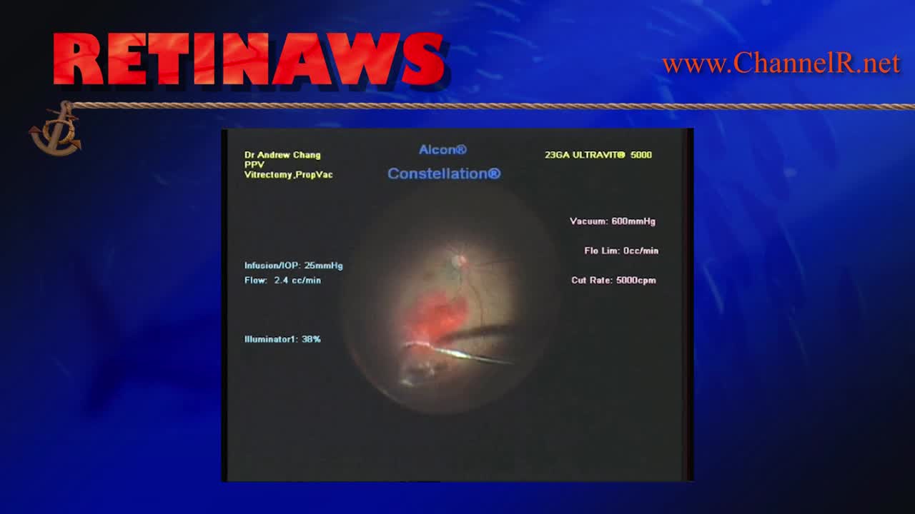 Accidental Retinotomy