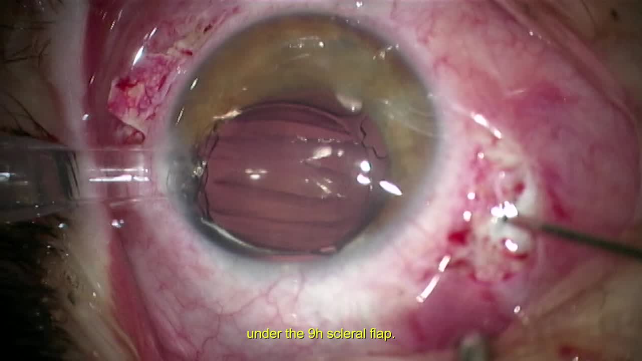 Carlevale Scleral Fixated Lens After Post-Traumatic Aphakia