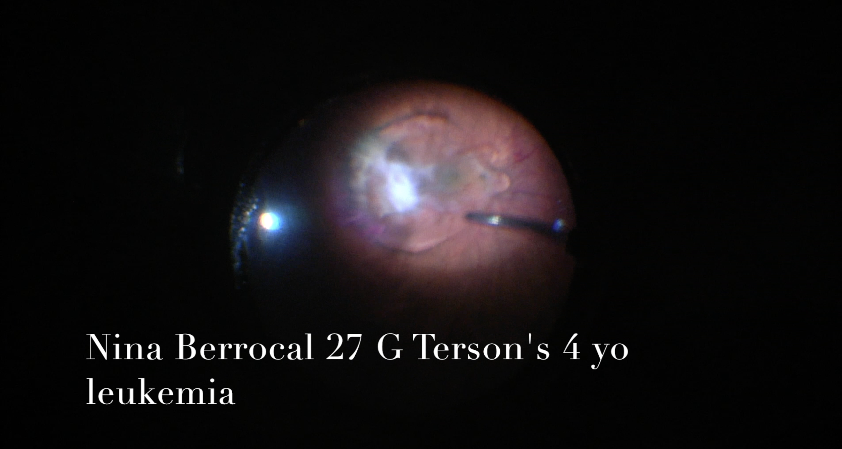 Surgical Repair of Macular Hemorrhage in a Child with Terson Syndrome from Acute Lymphoblastic Leukemia