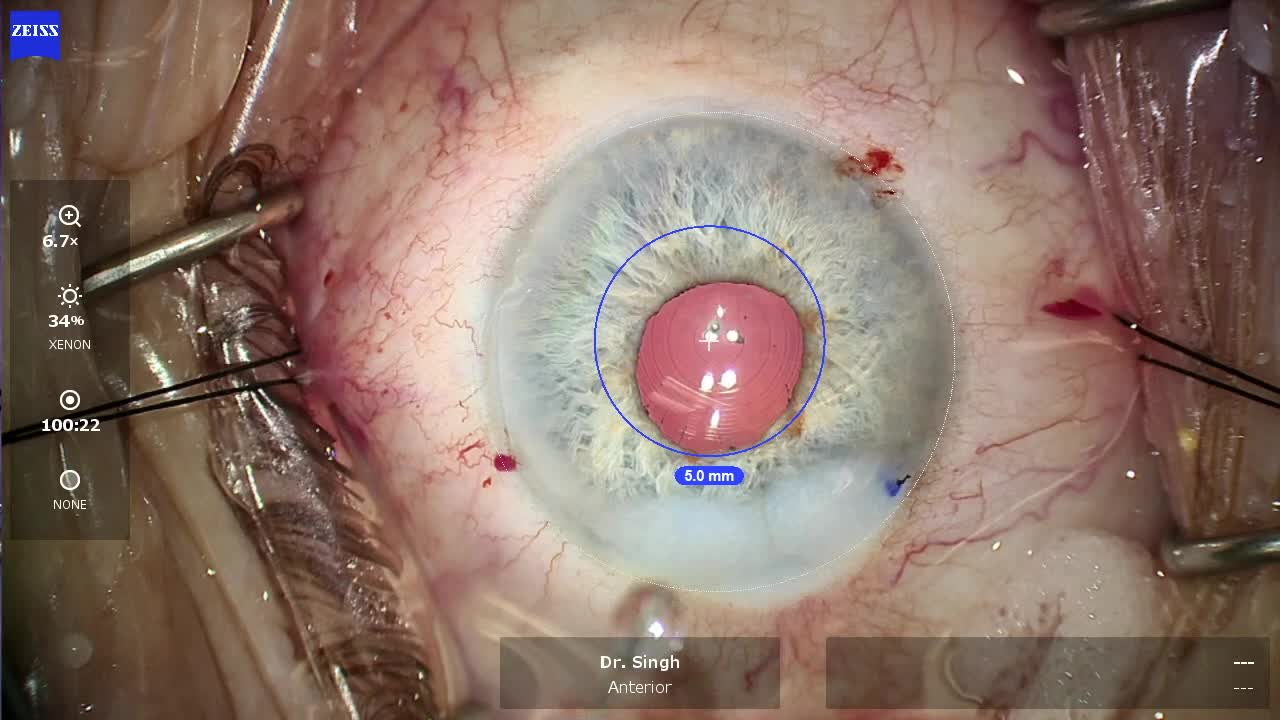 Multifocal IOL in a Small Pupil