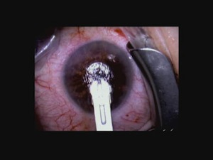 Implantation of the Presbia Microlens