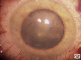 Retrobulbar Hemorrhage and 23G Leak-Free Incisions Made Easy