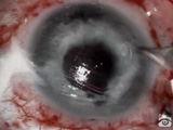 Refractive Surgery Pitfalls During Retinal Surgery