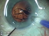 Implanting the Akreos MICS Lens