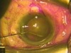 Iris Prolapse, Prolapse, Prolapse