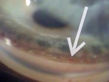 ELT: Excimer Laser Trabeculostomy, a Better Way to Treat Open-Angle Glaucoma