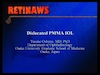 Dislocated PMMA IOL