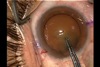 Devgan Rhexis Forceps
