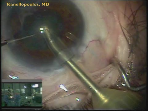Cataract Removal with Small Pupil and Ahmed Valve