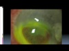 Total Anterior Segment Reconstruction