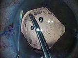 Lumera Illumination Technique for Complicated Cases
