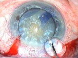 Completing Surgery With a Compromised Rhexis