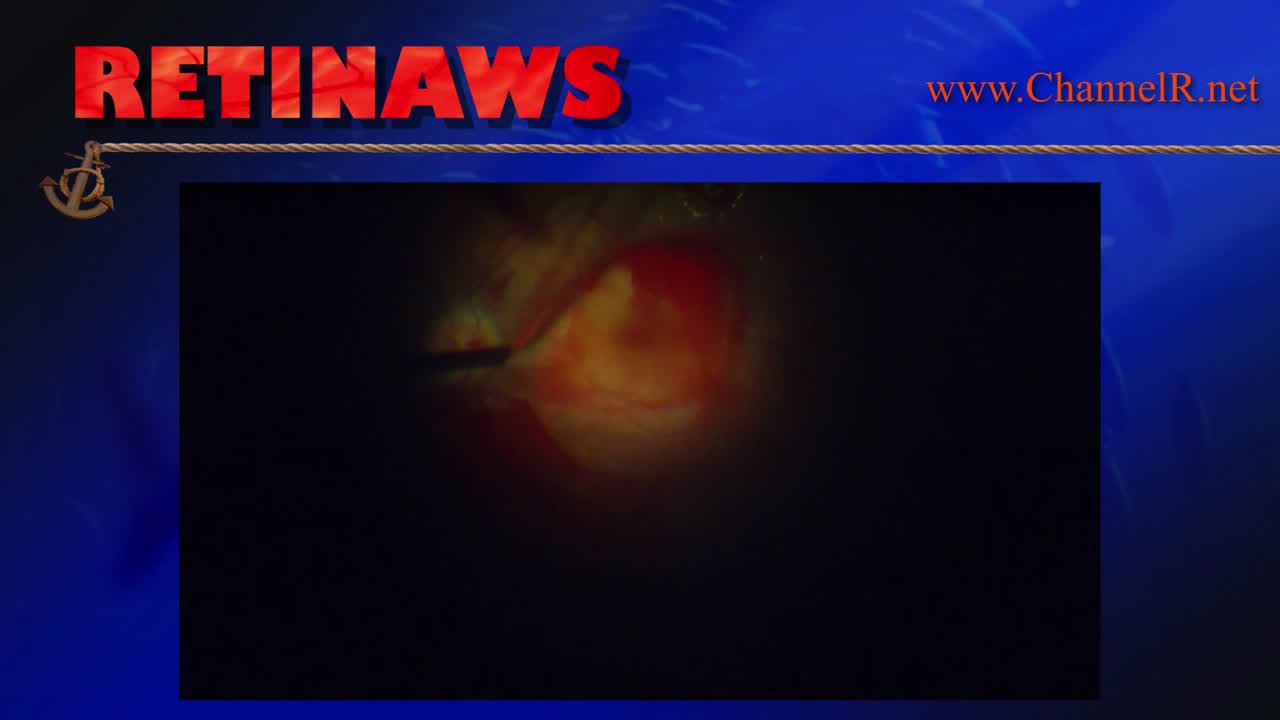 Sub-ILM Hemorrhage