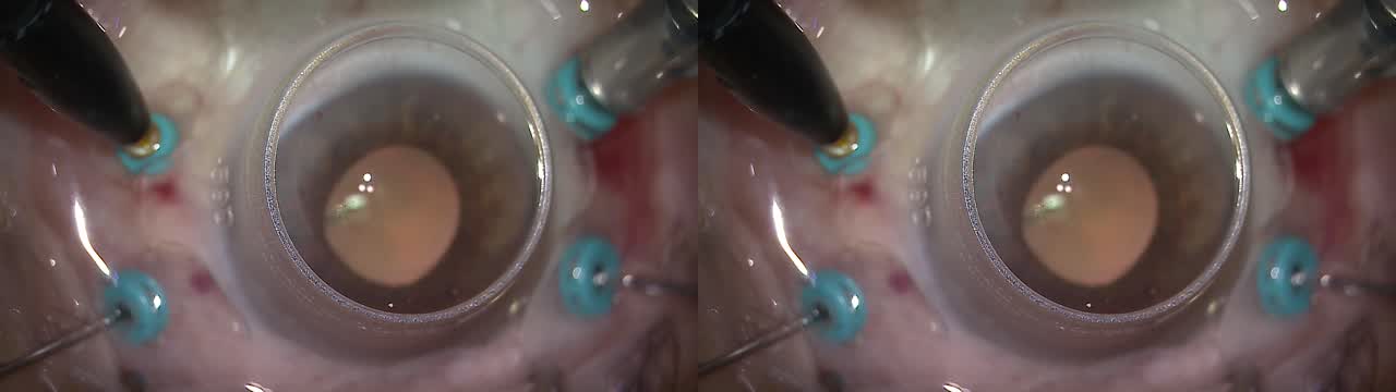 [2019] Amniotic Membrane Placement for Repair of Recurrent Macular Hole