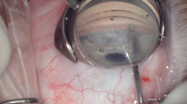 iDose: An Intraocular Drug-Eluting Delivery Device for Glaucoma