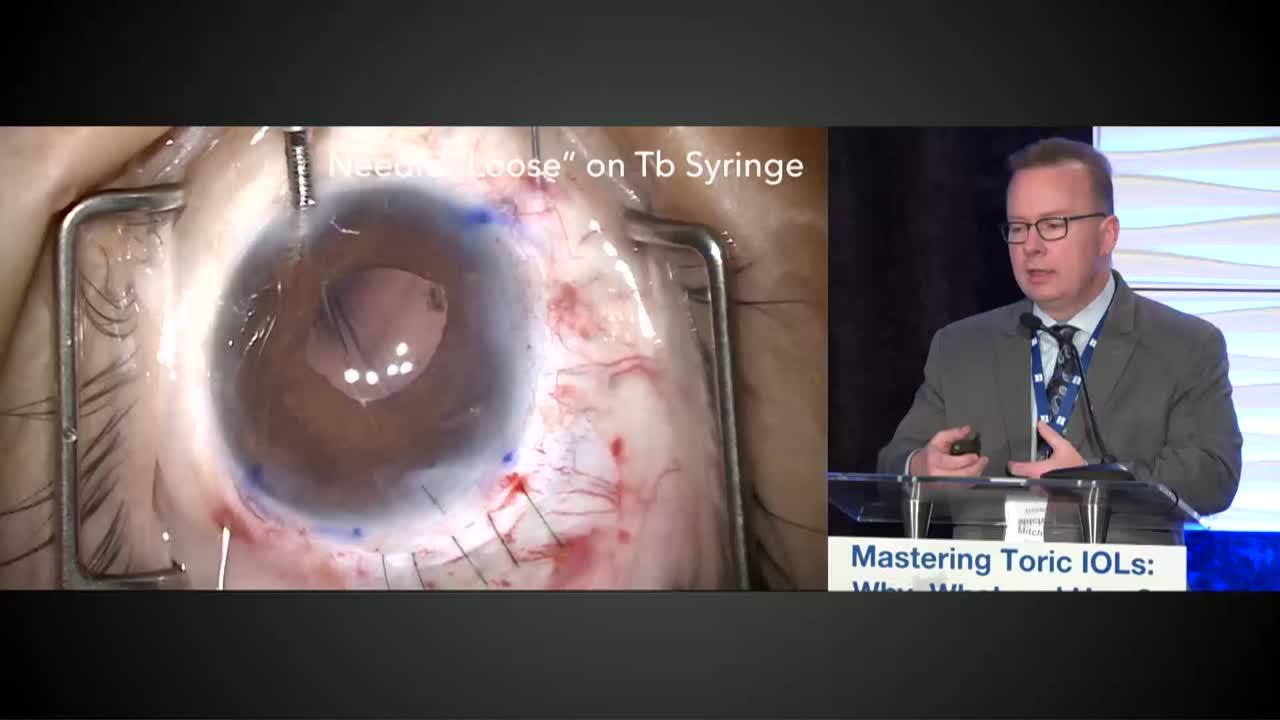 Toric IOL Q&A