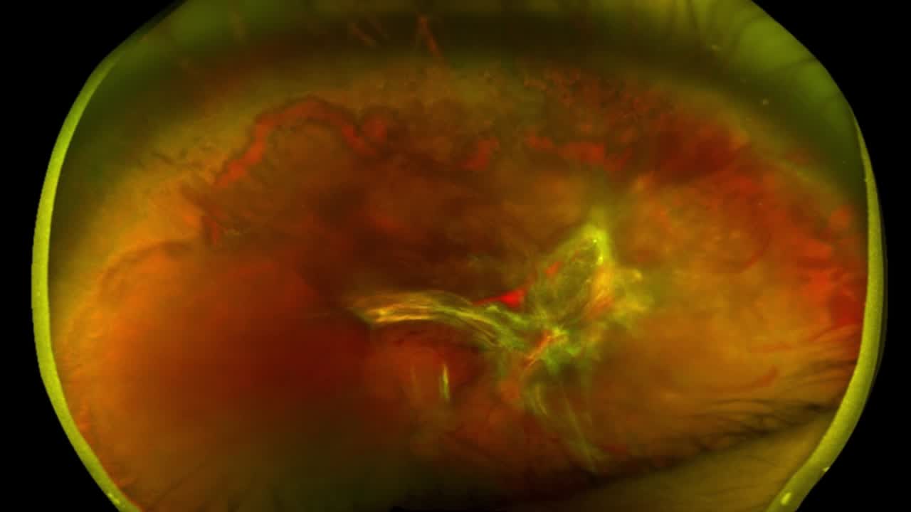 A Hybrid Vitrectomy