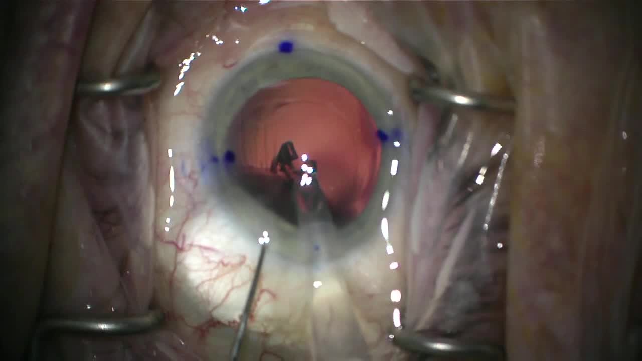 First Implantation of the RayOne Trifocal Toric IOL Worldwide