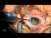 Two cases of 3D Sub 1mm MICS Surgery