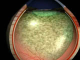 Vitrectomy - According to PVR Stage B: French Audio Version: