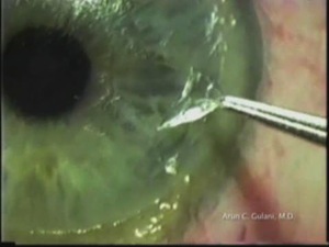 Laser PRK not PTK: Corneal Scars to 20/20 Vision