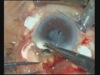 Expulsive Hemorrhage - What To Do and Not To Do