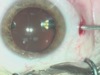 20-Gauge Transconjunctival Sutureless Vitrectomy
