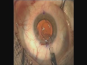 Phakic IOL Explant and Cataract
